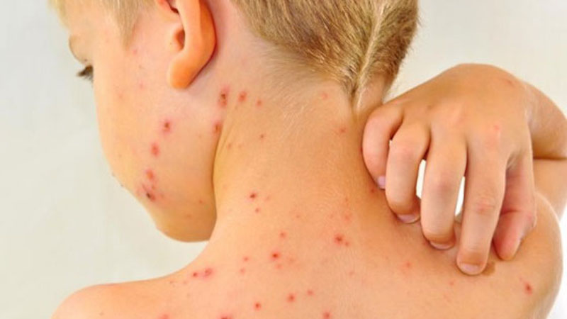 Varicella party: la Regione stronca la proposta di una mamma no-vax