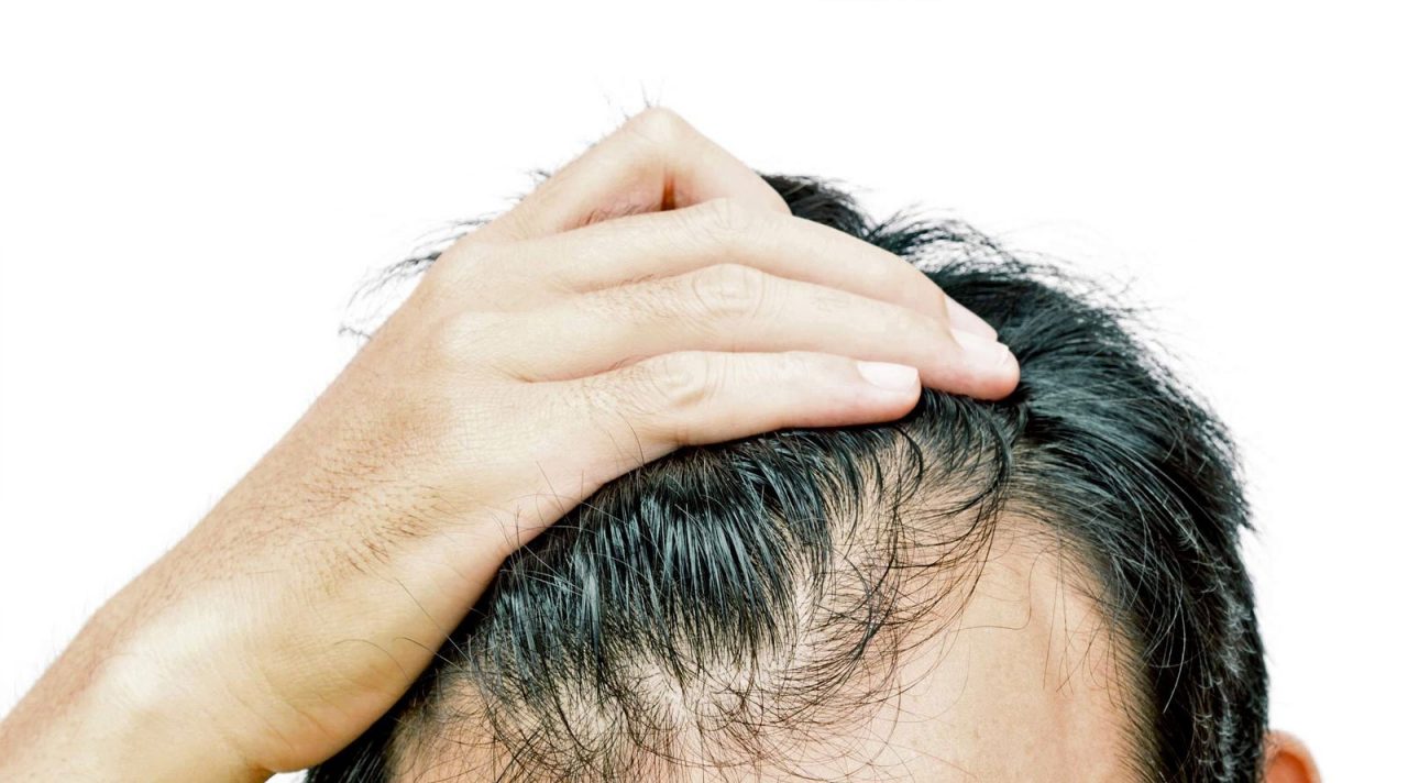 Caduta dei capelli nell’uomo, perché accade e come si risolve