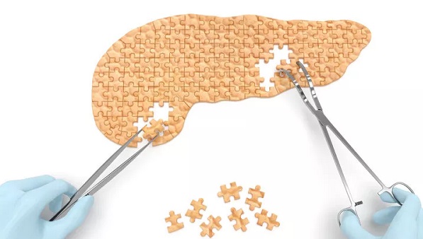 Humanitas in prima linea per la lotta al tumore al pancreas