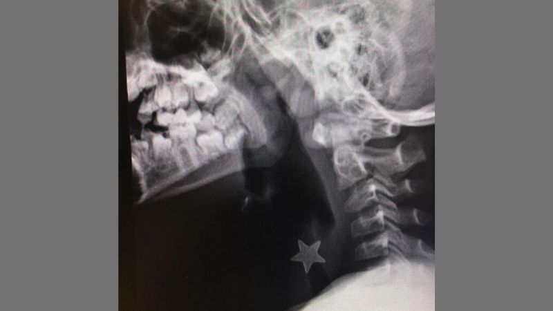 Una stellina incastrata nella trachea di un bambino: salvato al Niguarda